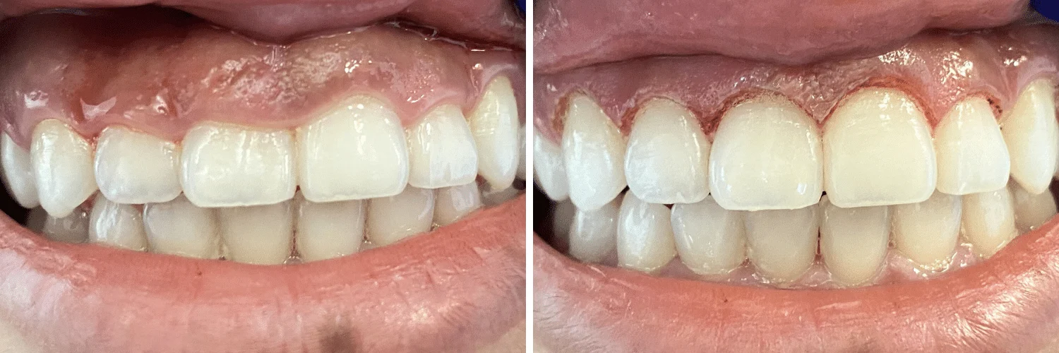 gum contouring