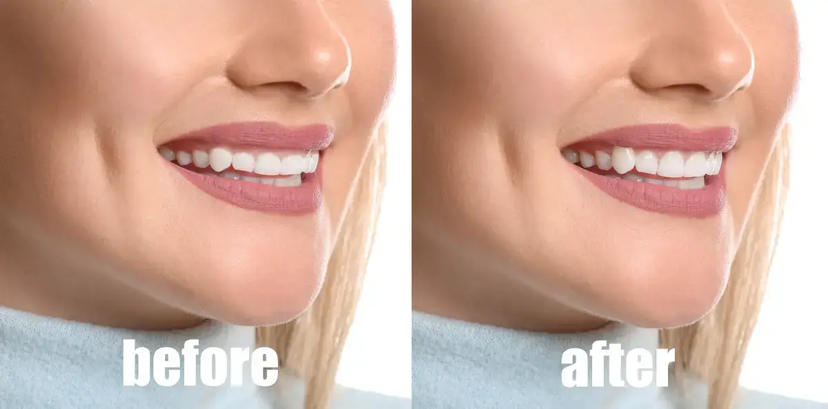 gum contouring1