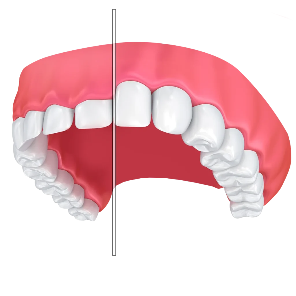 gum contouring3
