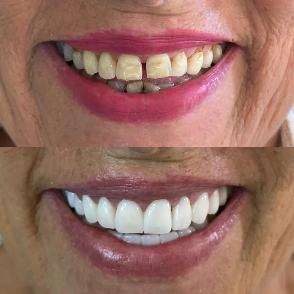 zirconia crowns Dental Tourism Albania