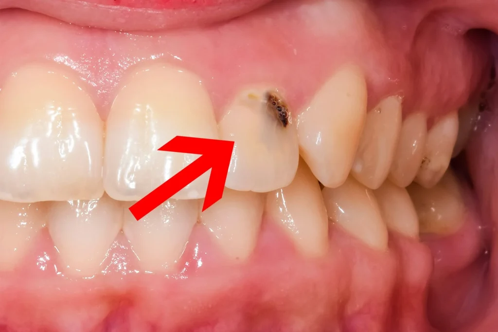 CAVITY 