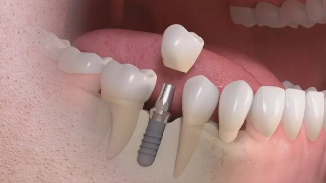 COSTI DI UN IMPIANTO DENTALE