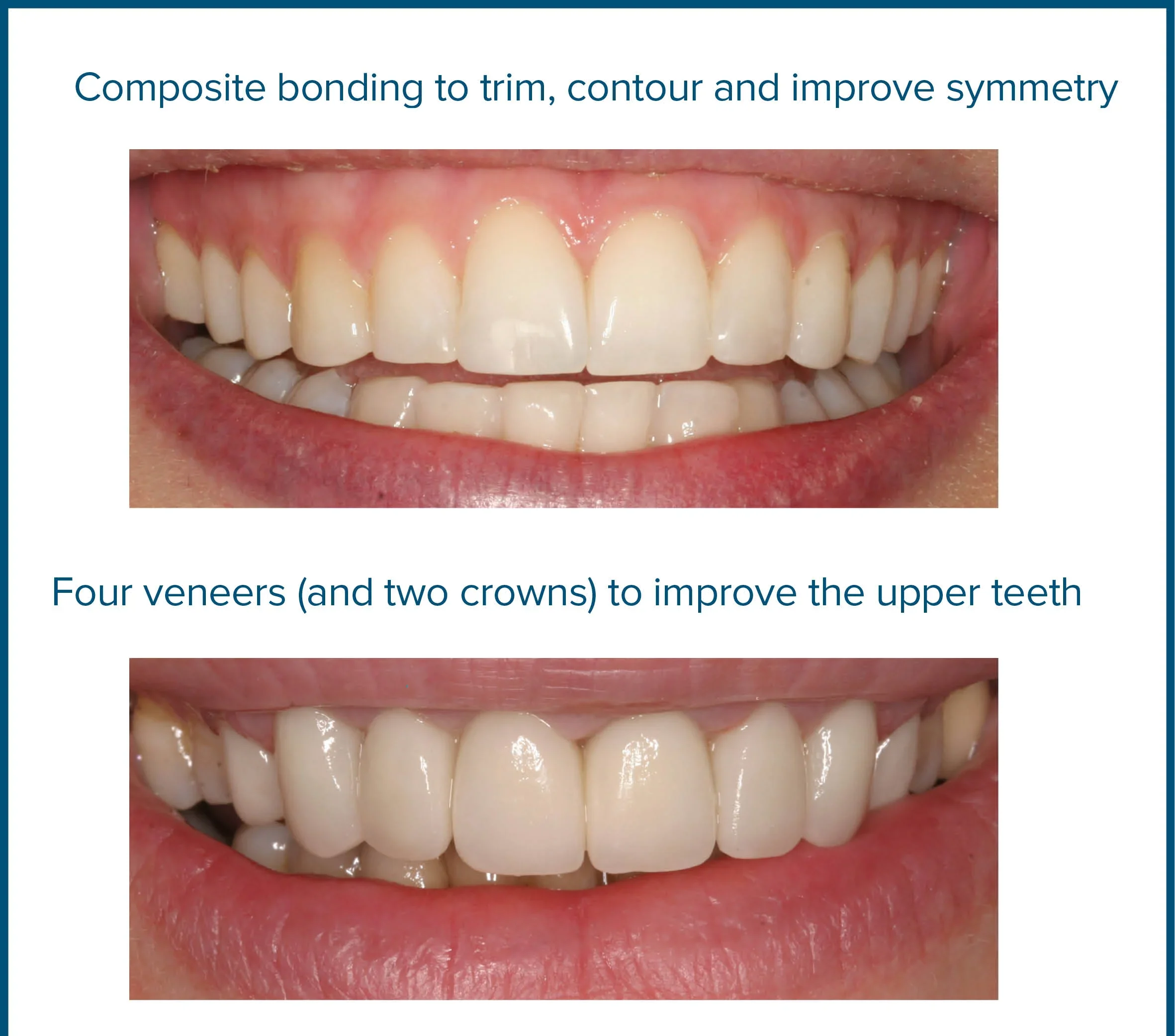 Composite Resin Bonding Teeth