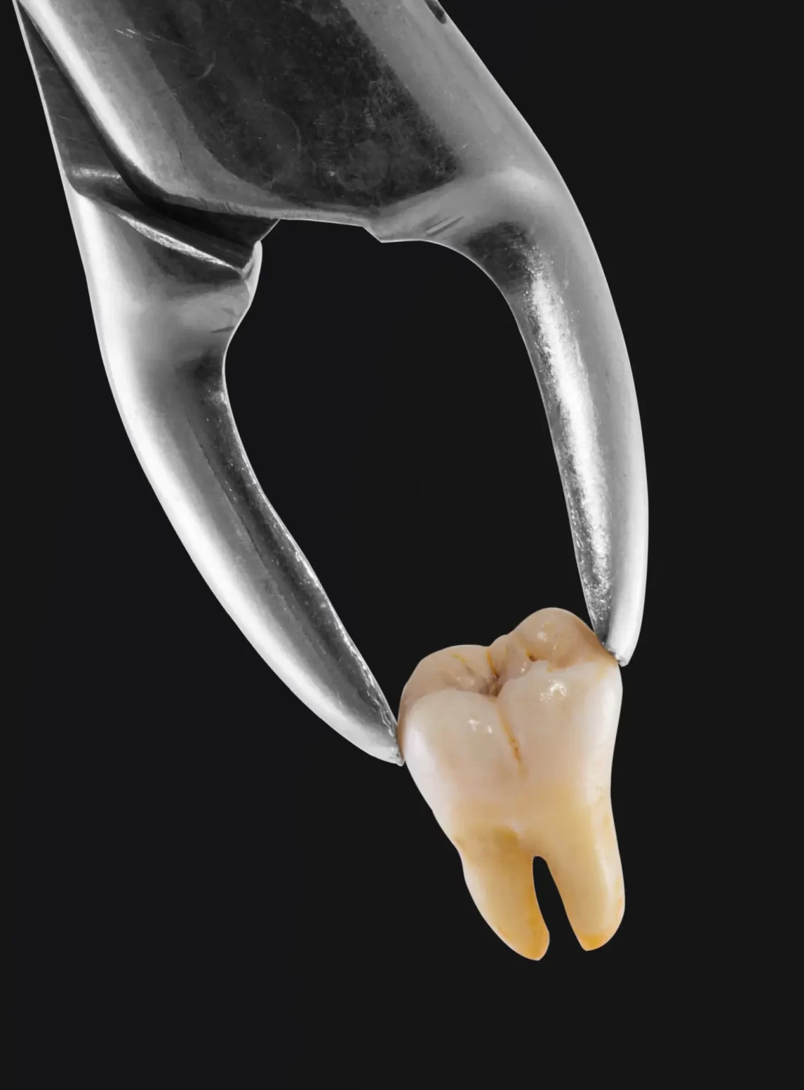 Estrazione del dente1