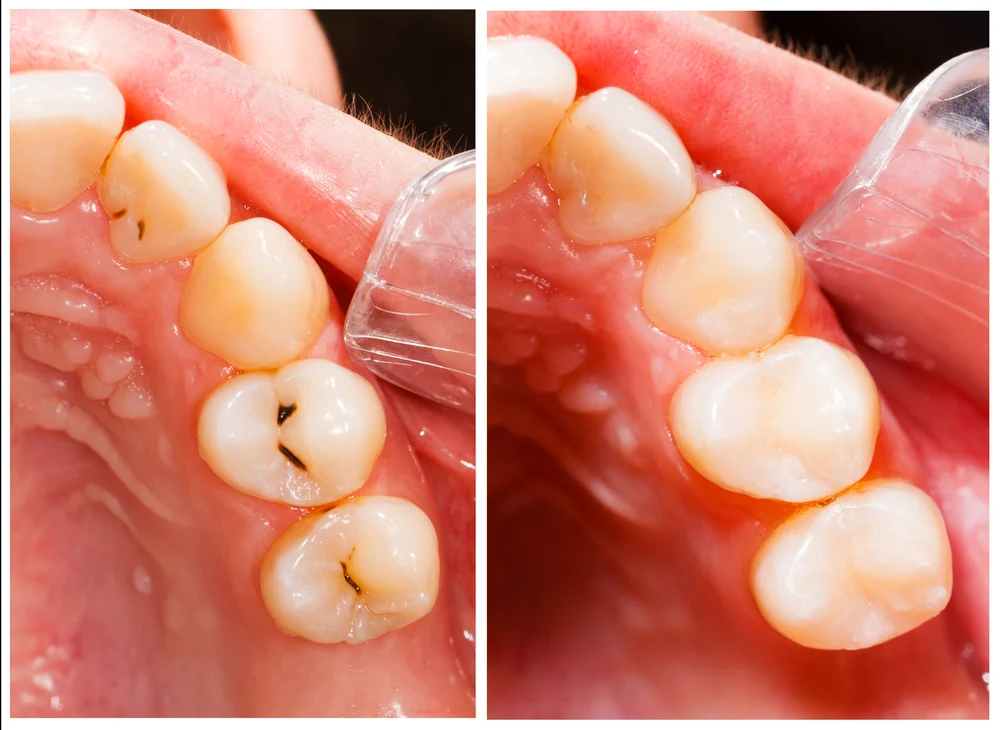 Fissure Seals