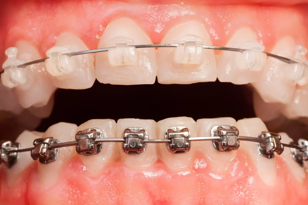 Fixed Braces1