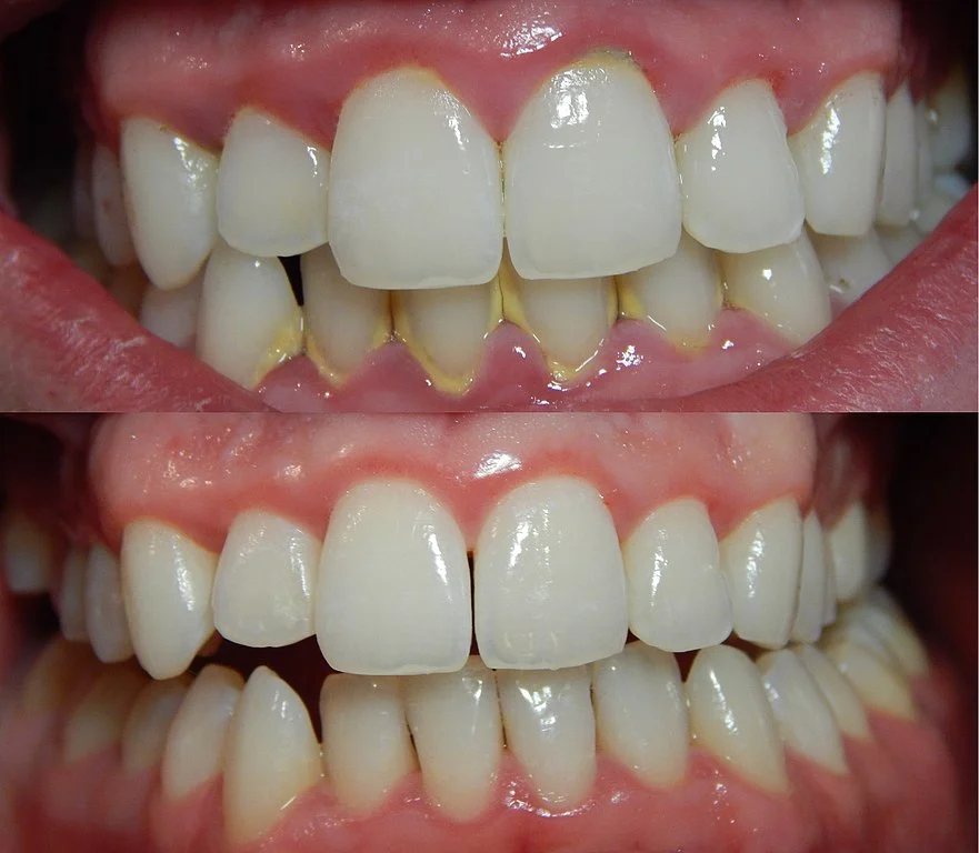Gingivitis 