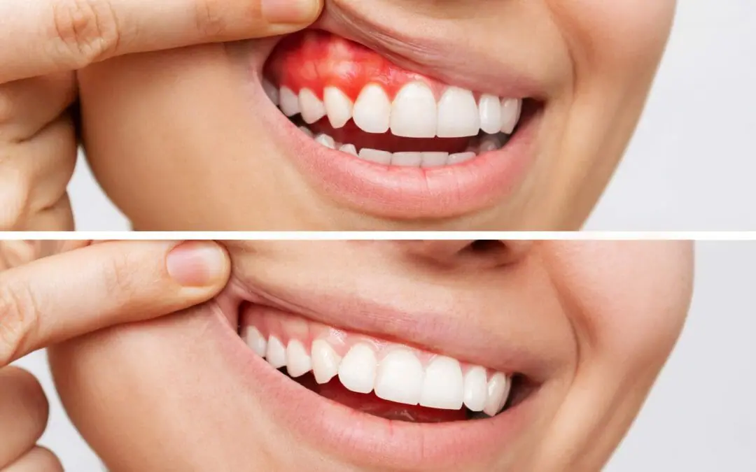 Gum Disease Treatment2