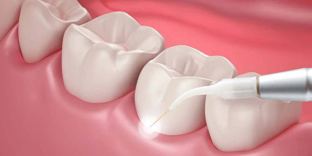 Gum Disease Treatment3