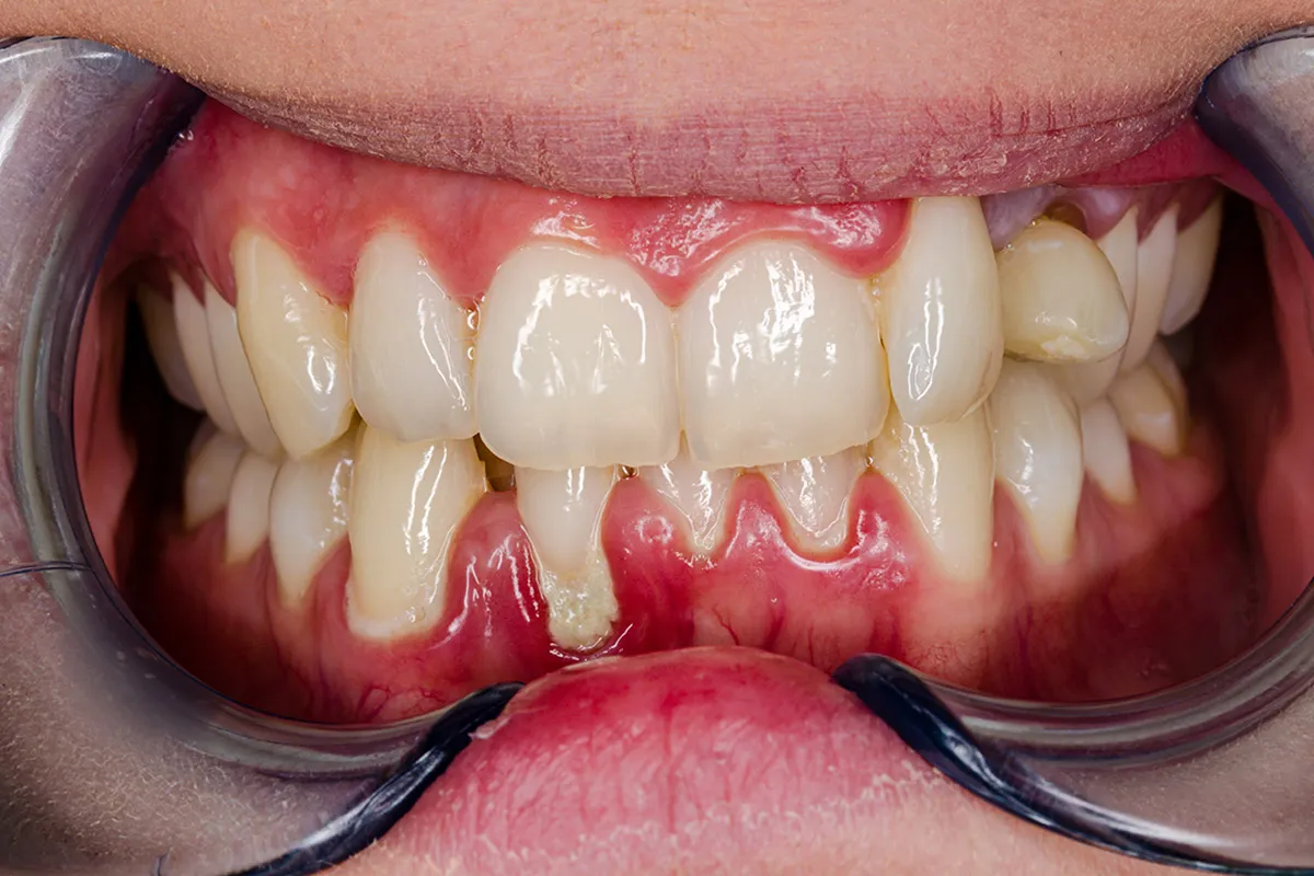 Gum Disease Treatment4