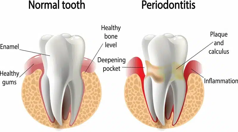 How To Cure Gum Disease Without A Dentist
