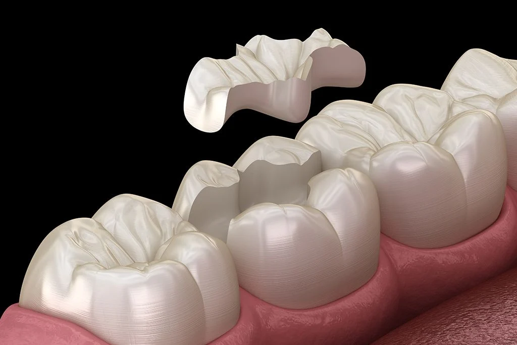 Intarsio Dentale