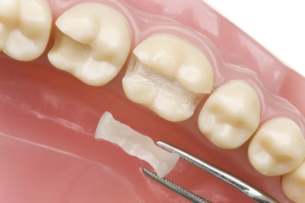Intarsio Dentale2