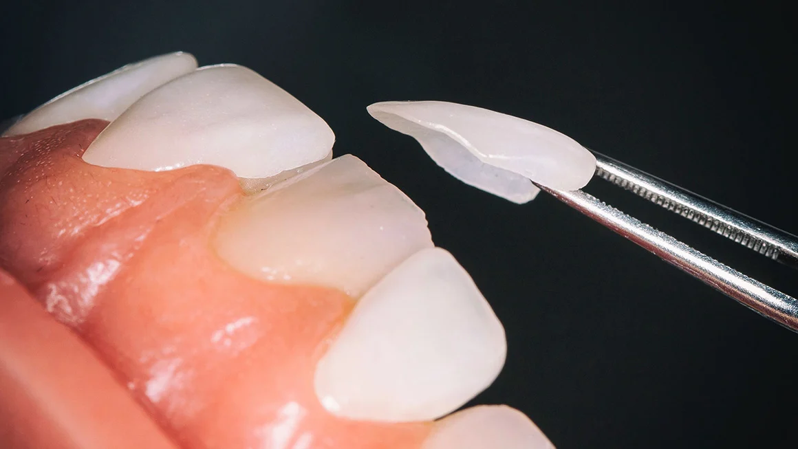 Laminate teeth veneer