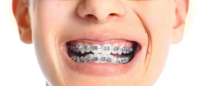 NHS Braces