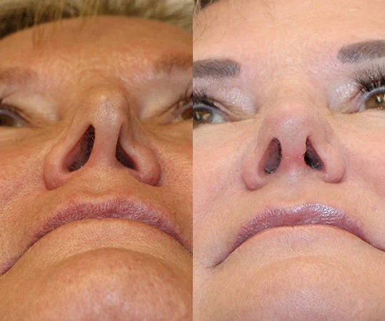 Nostril Collapse