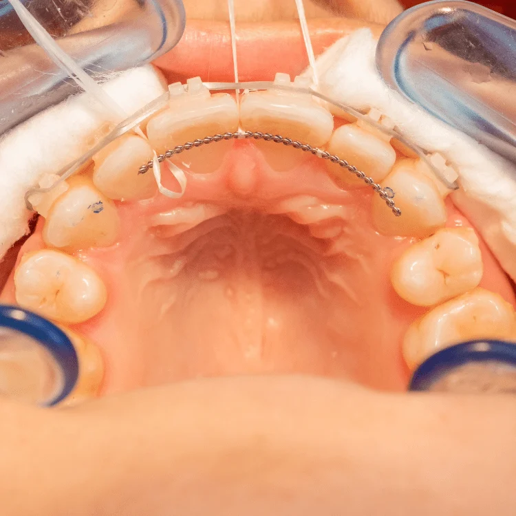 PERMANENT BRACES