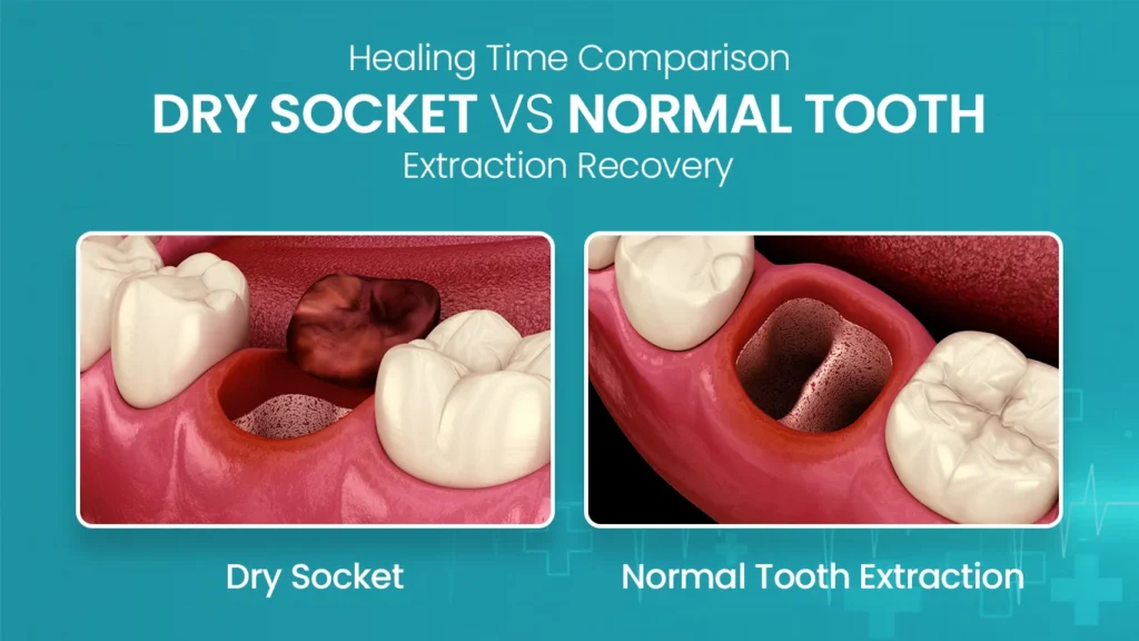 Recovery Time For A Pulled Tooth