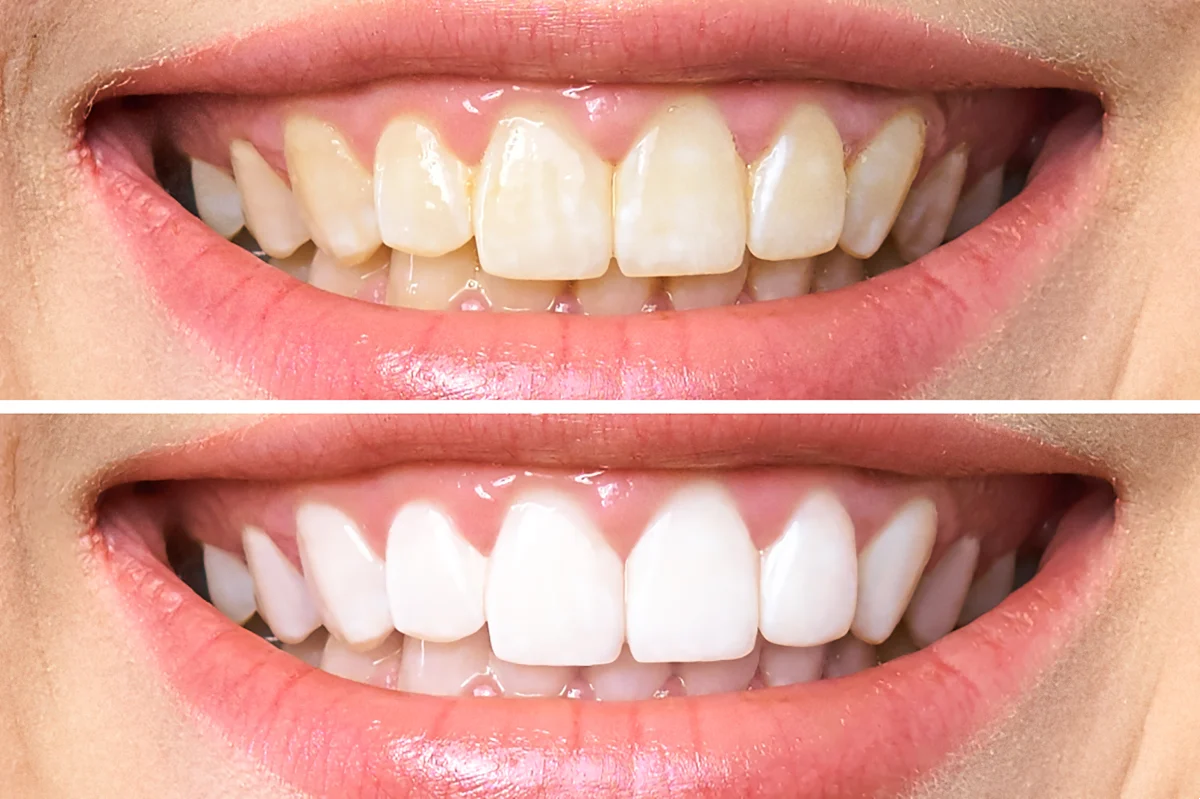 Sbiancamento dei denti