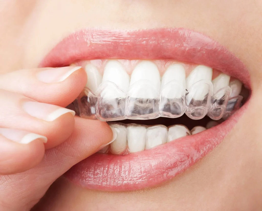 Sbiancamento dei denti1