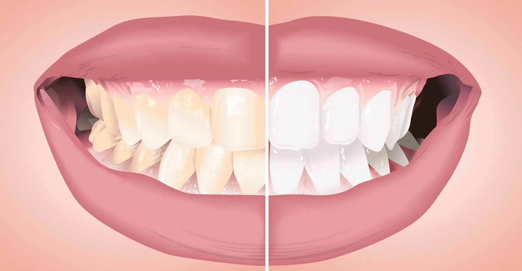 Sbiancamento dei denti3