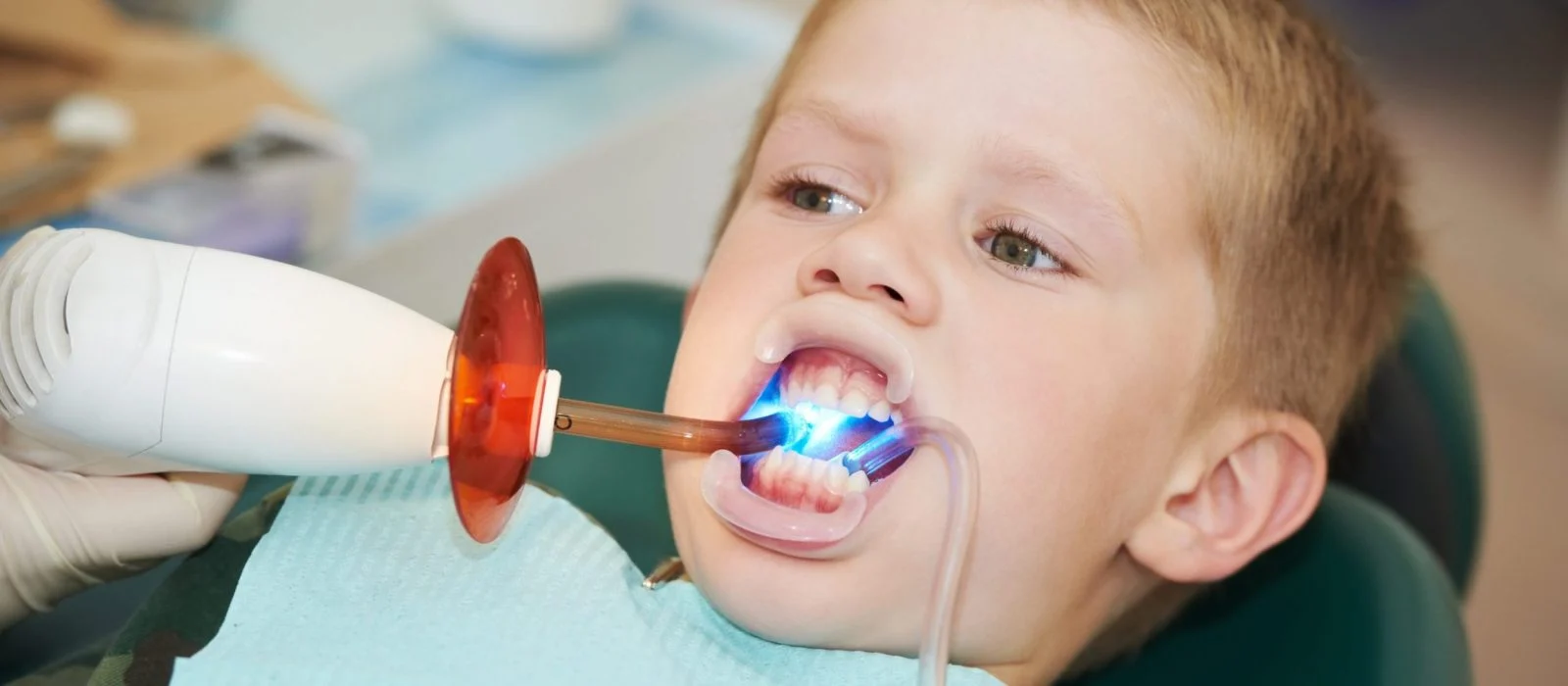 Sigillanti dentali3