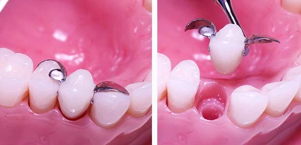 Single False Tooth