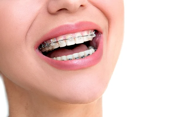 Tooth Straightening