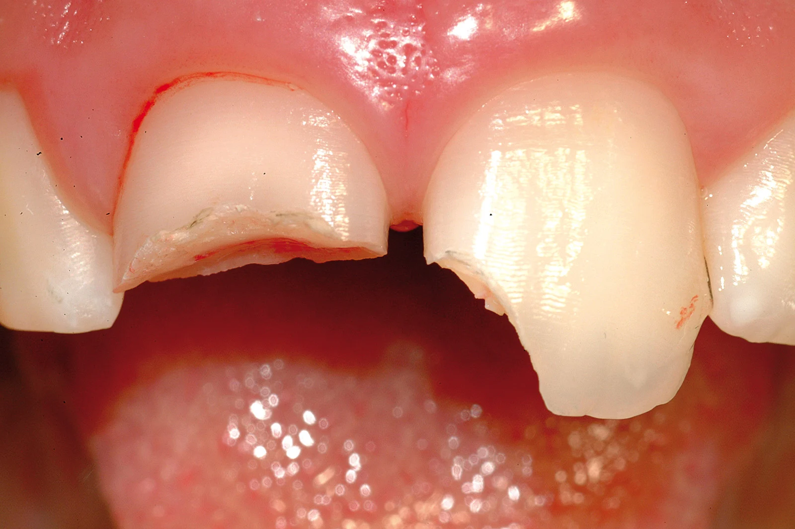 Trauma dentale