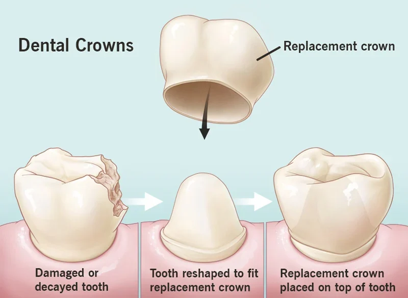 What Is A Crown