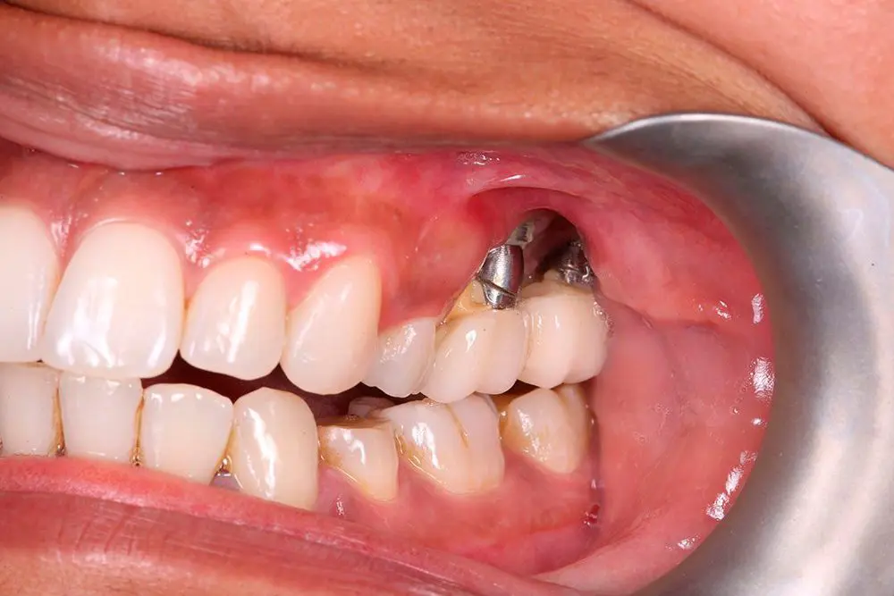dental implants turkey