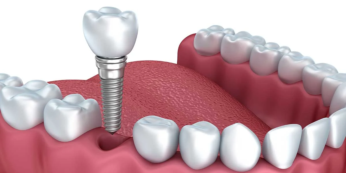 single tooth implant2