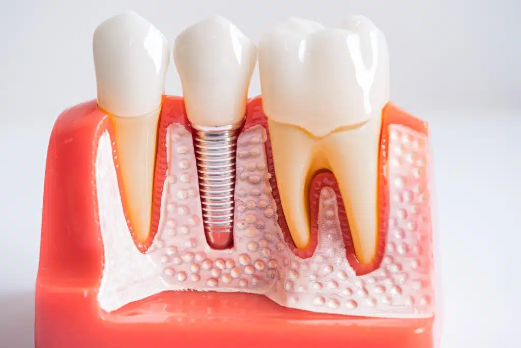 single tooth implant3