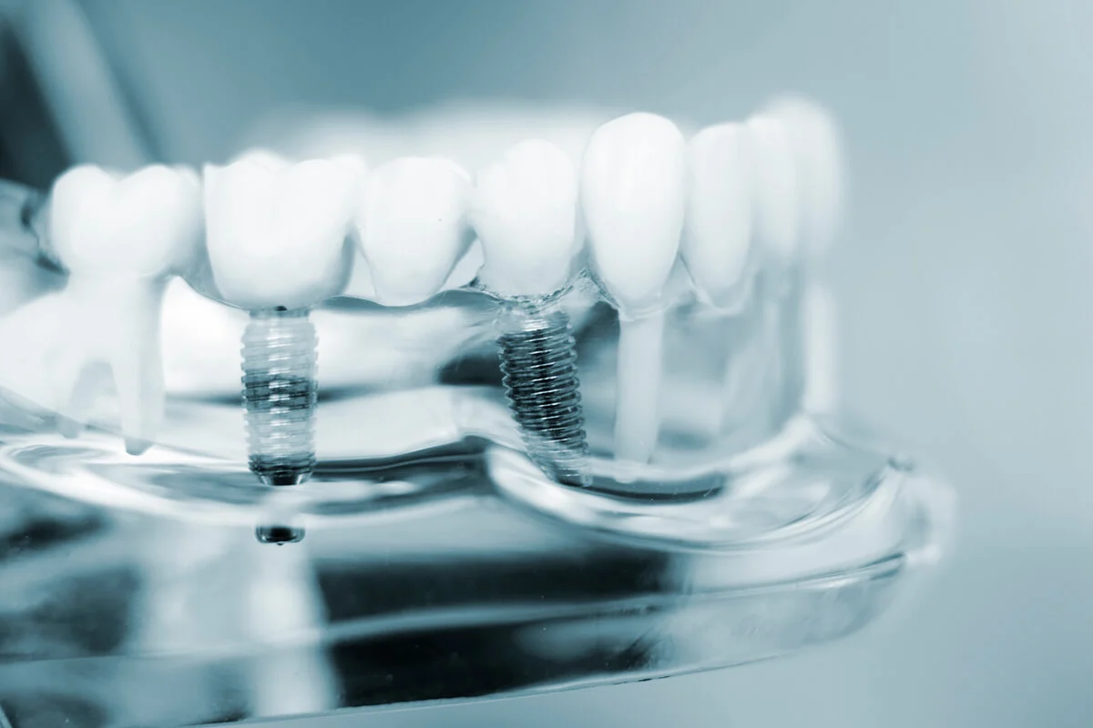 single tooth implant4