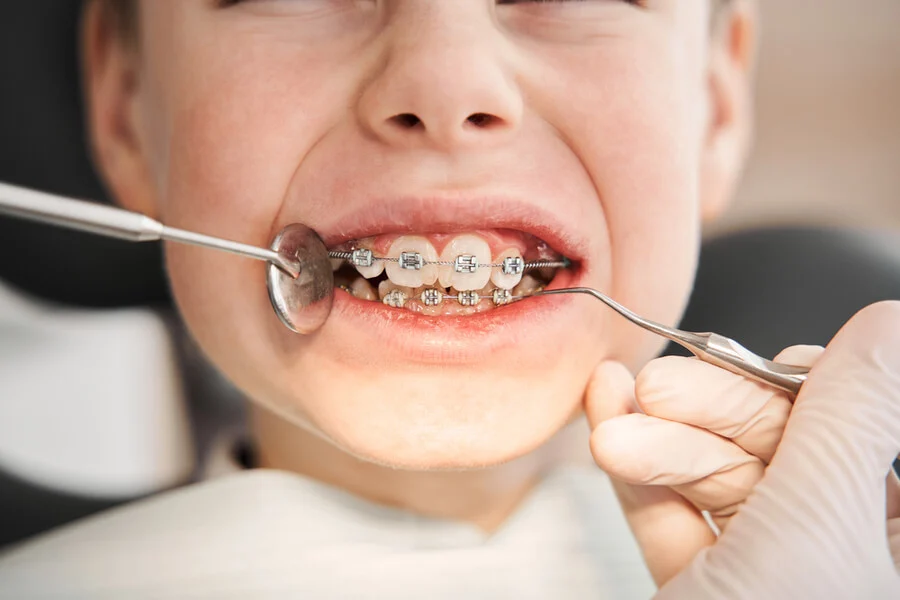 Apparecchio Bambini Per Malocclusione