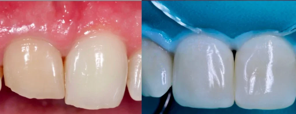 Composito Per Denti