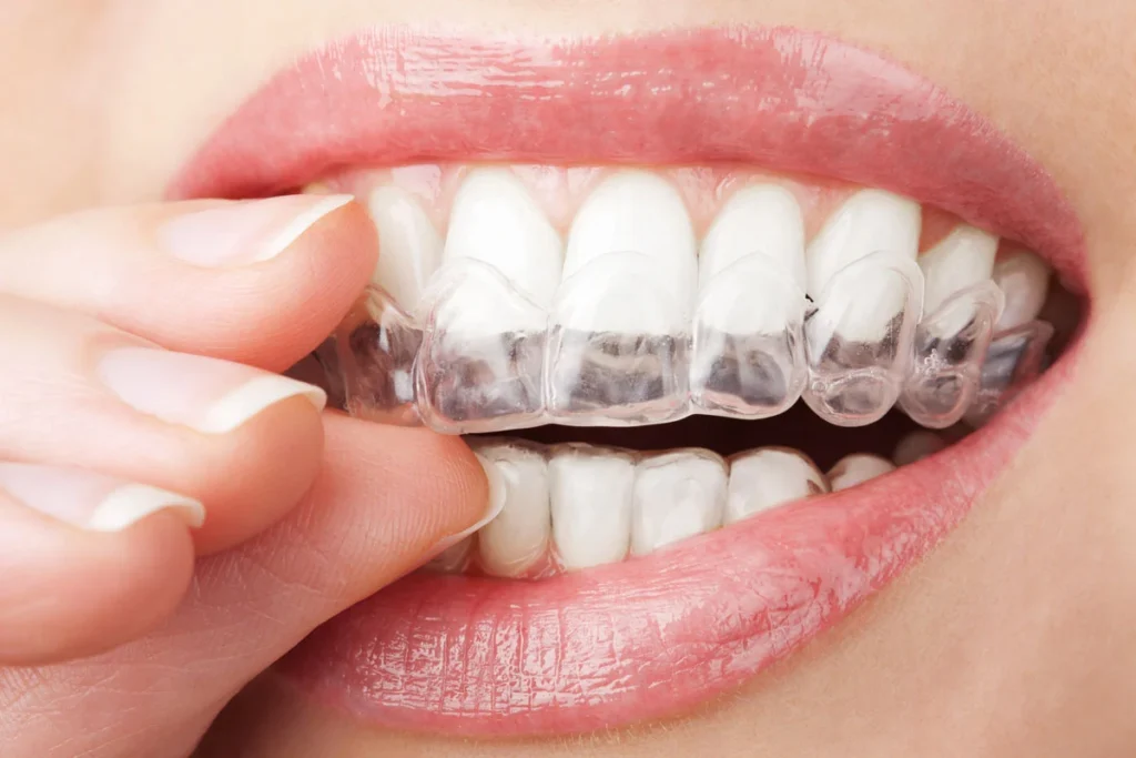 Contenzione Denti