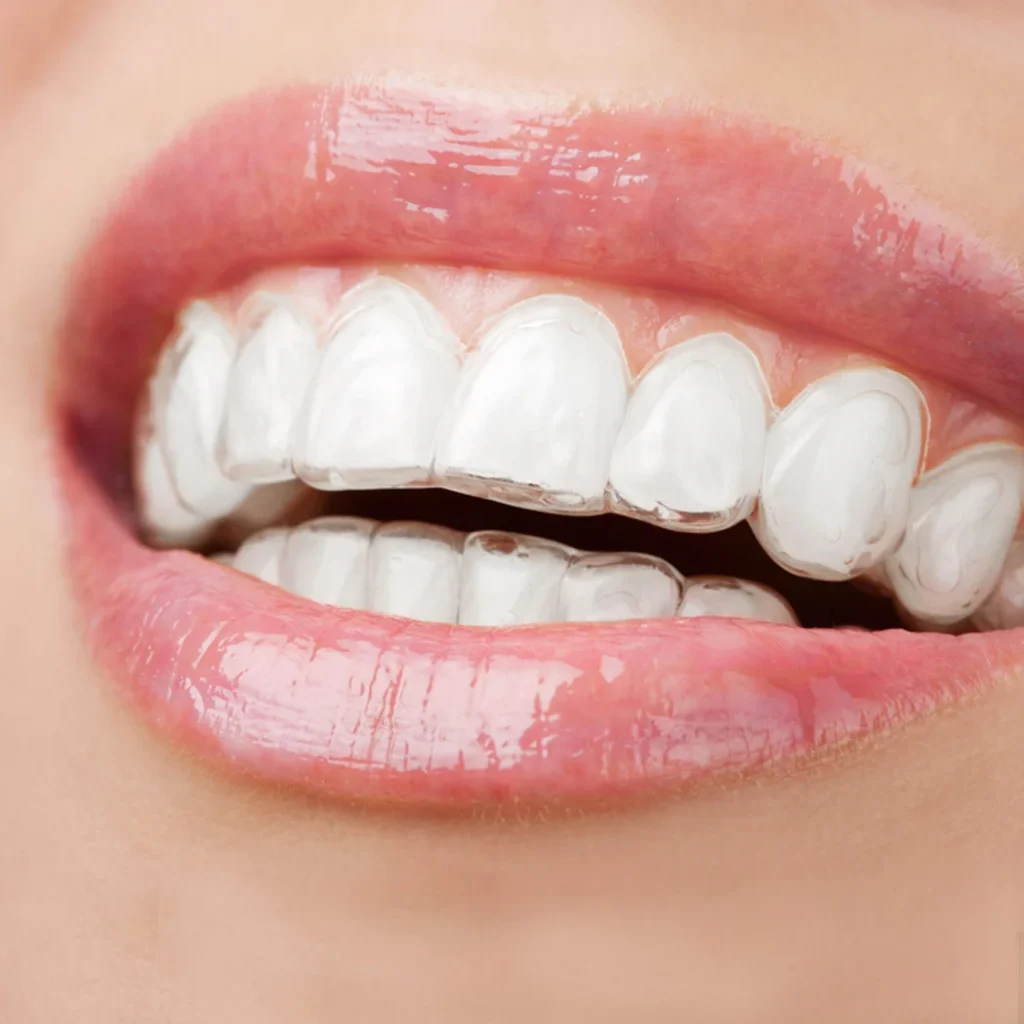 Contenzione Denti