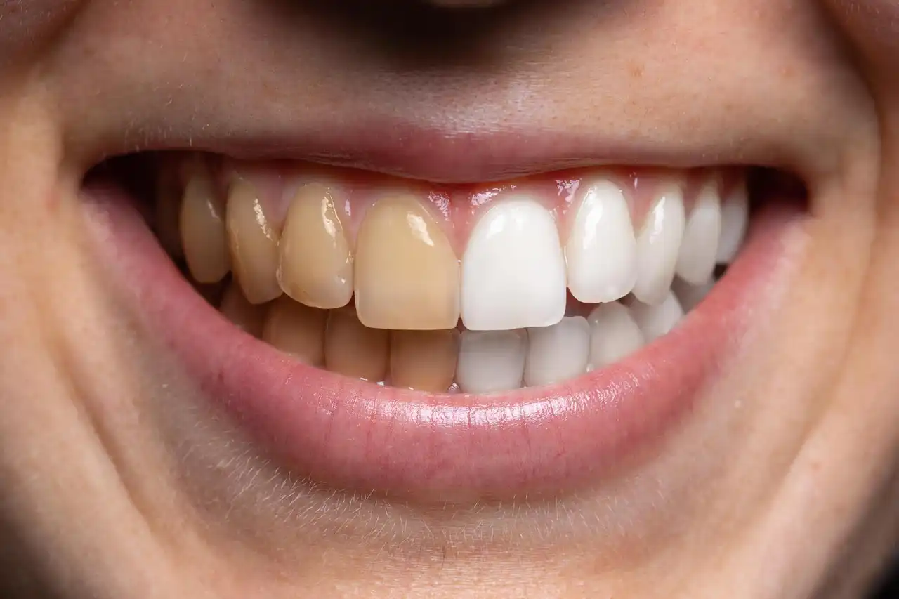 Denti Bianchi