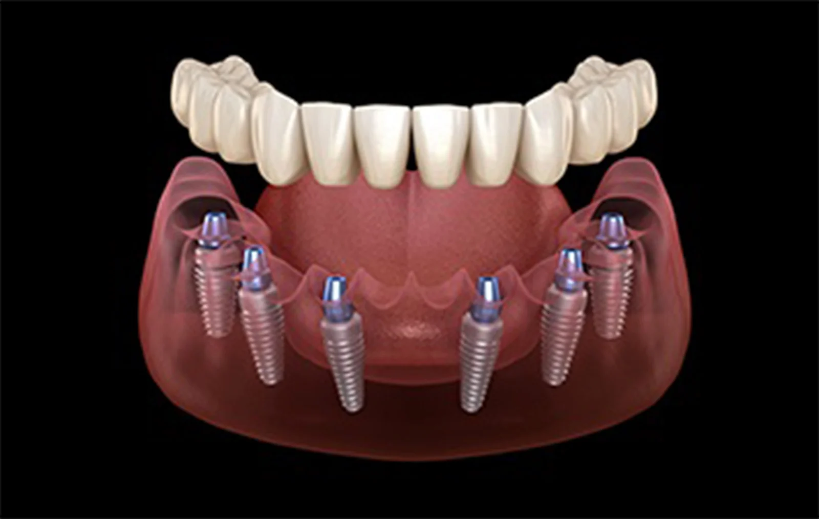 Denti Impianto Fisso