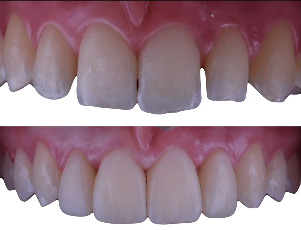Denti Resina
