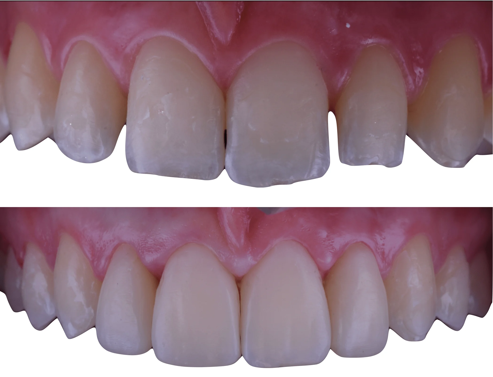 Denti Resina