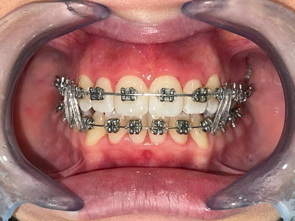 Dentista Apparecchio