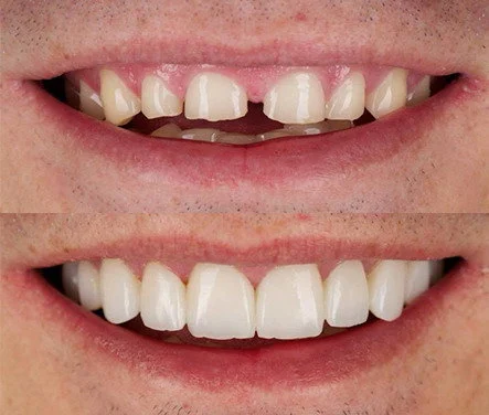 Faccette Ceramica Per Un Sorriso Perfetto