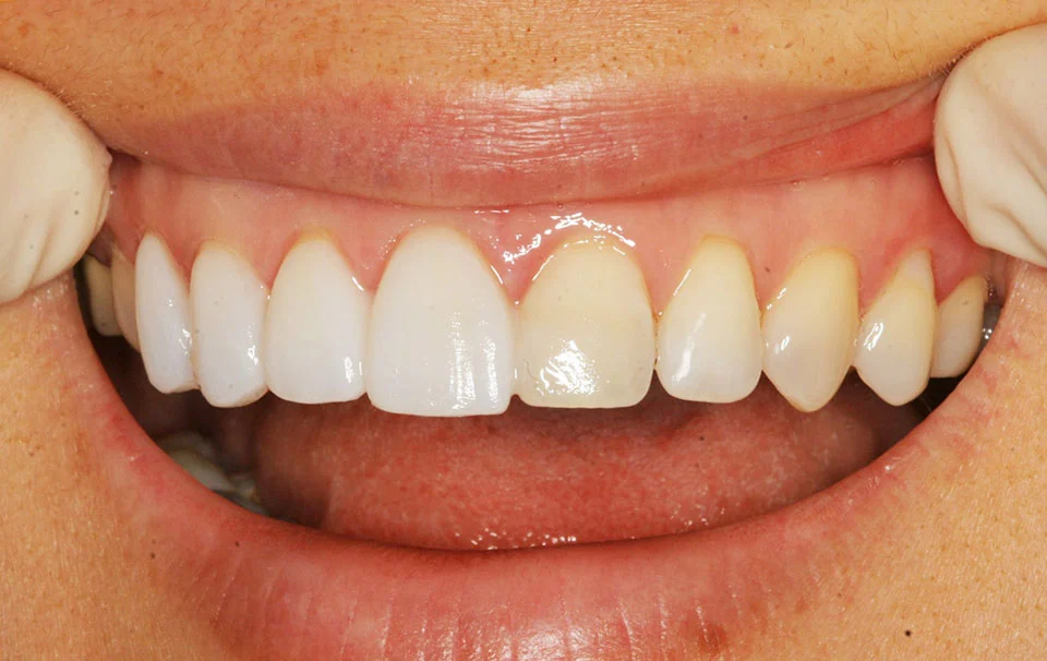 Faccette Estetiche Per Denti