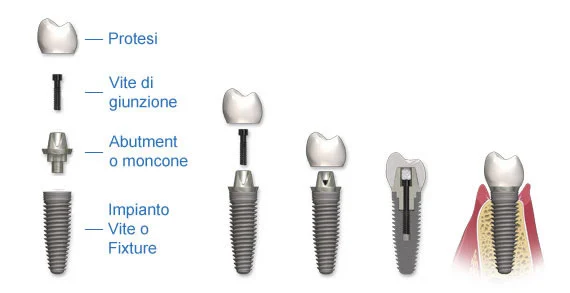 IMPIANTI AL TITANIO DENTI