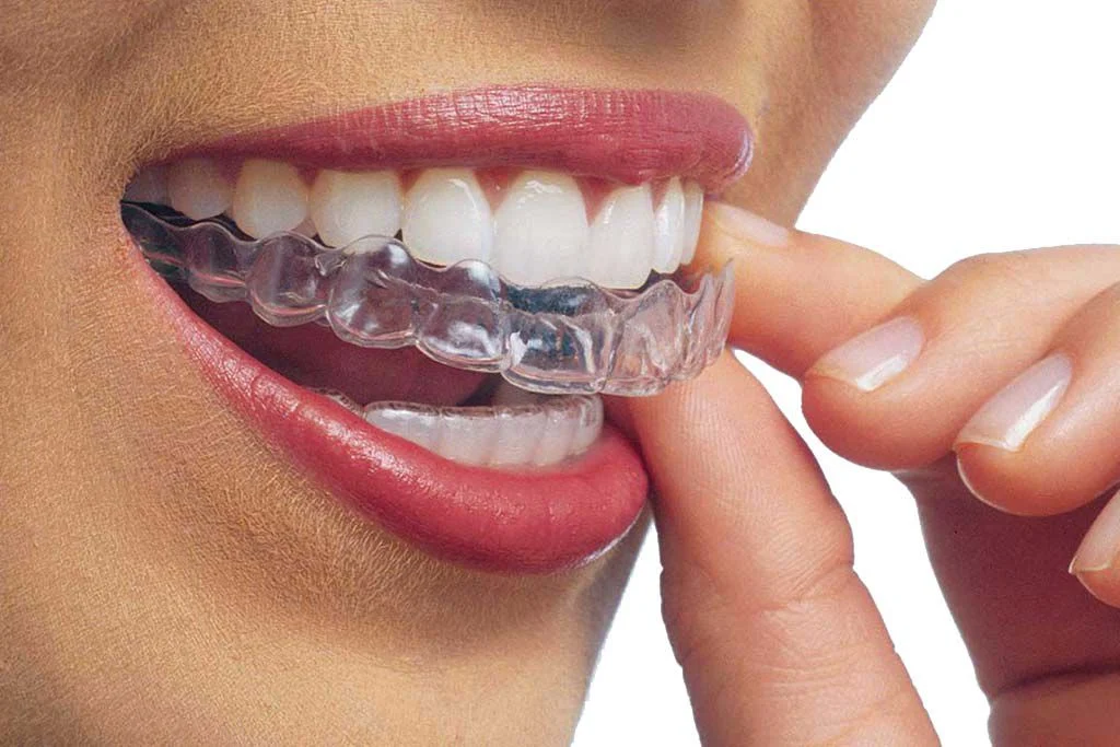 Mascherina Per Denti Trasparente