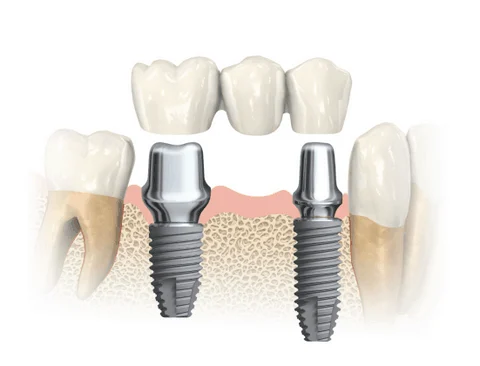 Perni Dentali