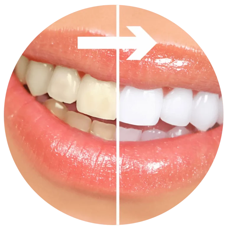 Quanto Costa La Sbiancatura Dei Denti