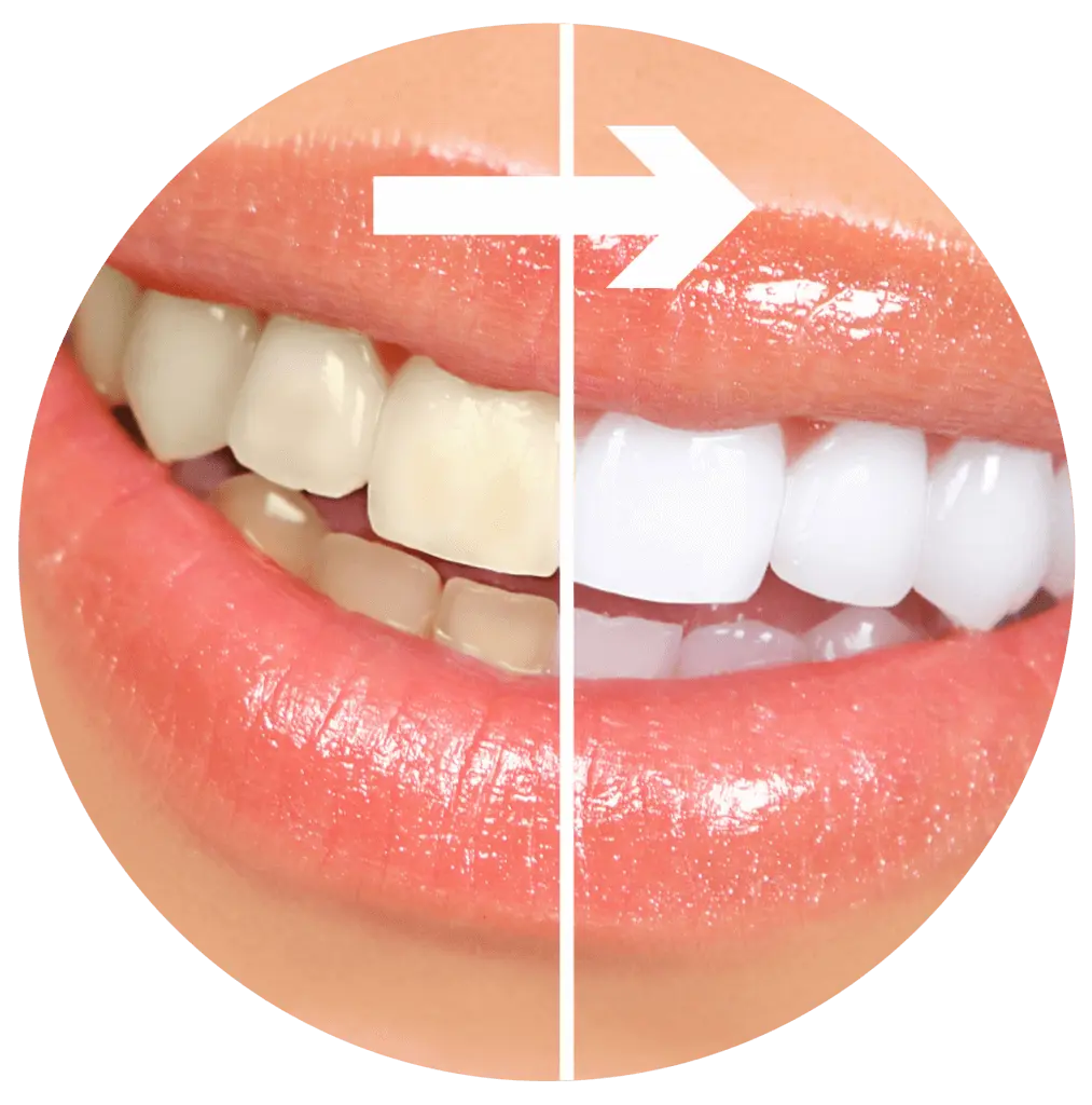 Quanto Costa La Sbiancatura Dei Denti